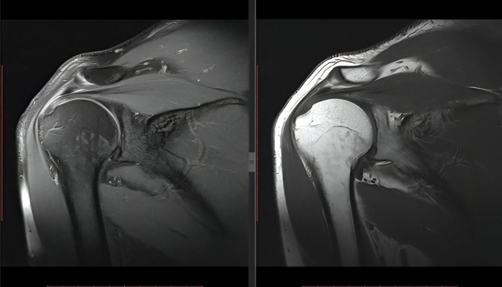 Shoulder Bones