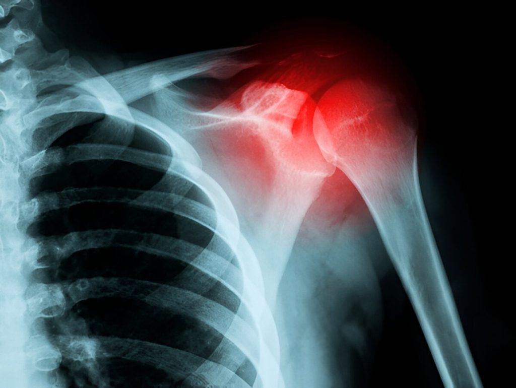 Shoulder MRI anatomy