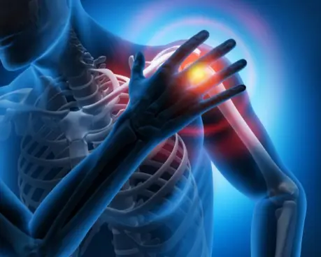 Digital rendering of shoulder impingement syndrome with red pain highlight.