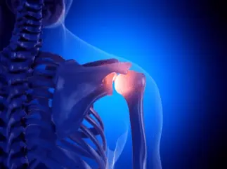 X-ray style image showing inflammation in the shoulder joint.