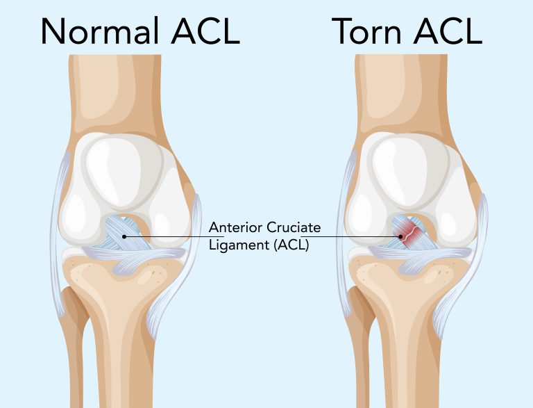 normal and torn ACL