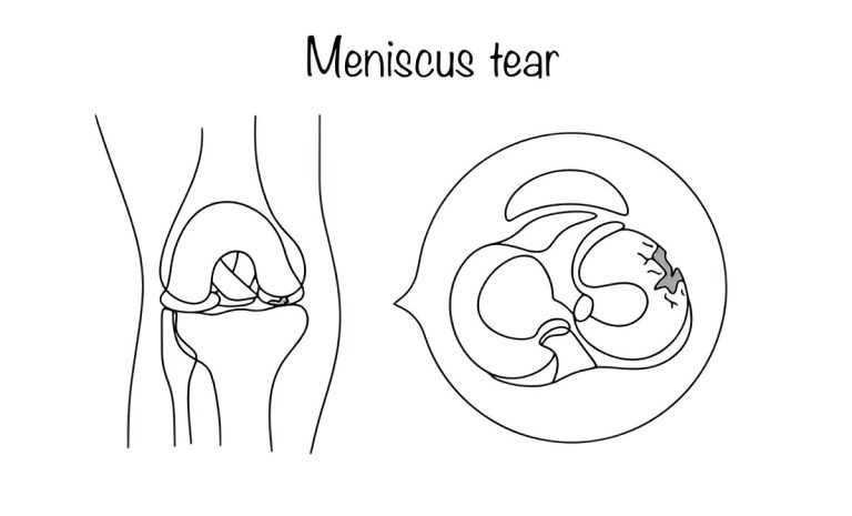 Meniscus