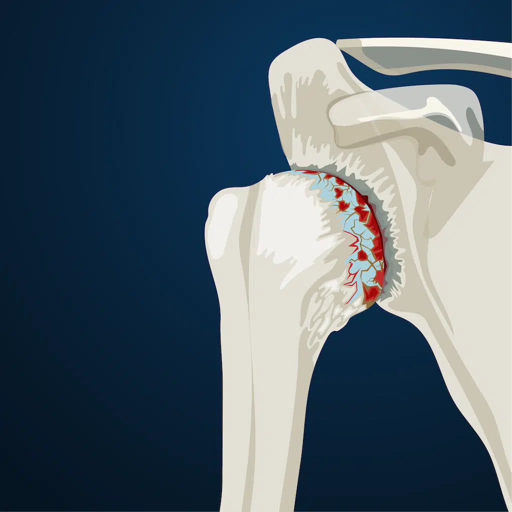 3D medical illustration of shoulder joint with visible cartilage damage.