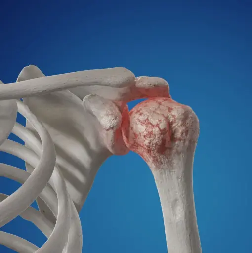3D rendering of shoulder joint with highlighted bone friction and damage.