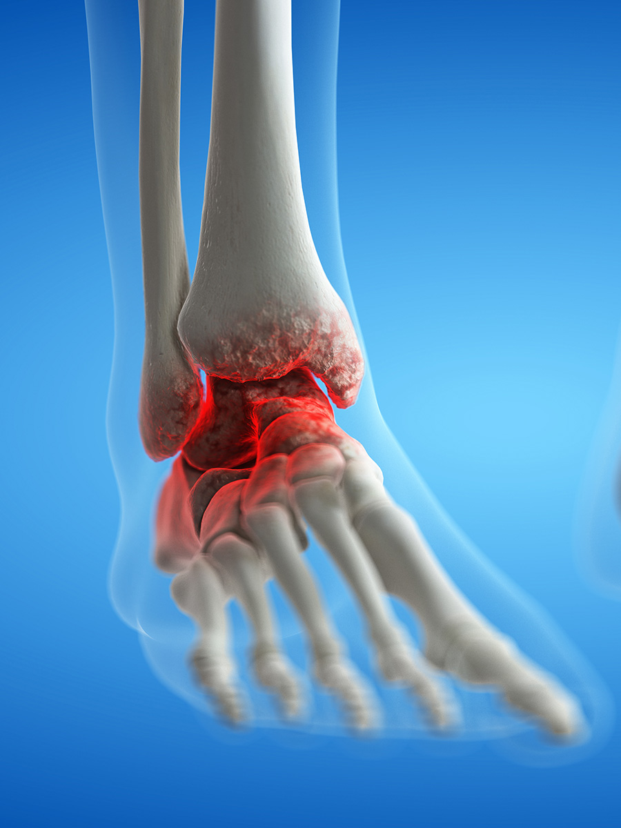 a diagram of a persons ankle with arthritis
