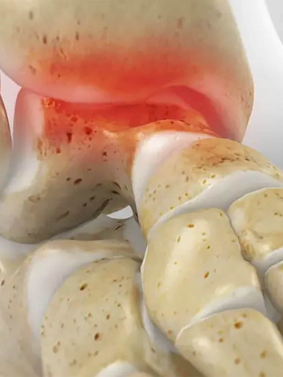 Model of a foot with ankle pain