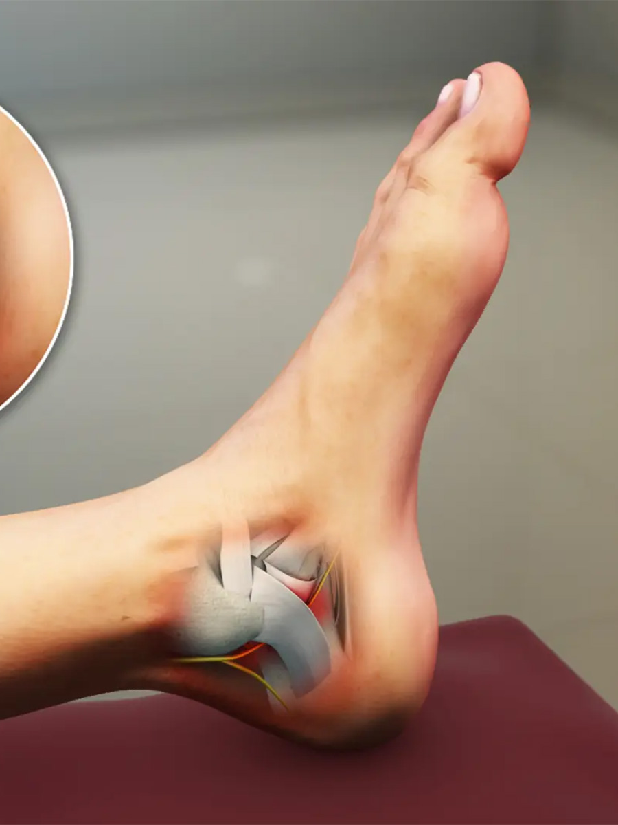 Diagram of the heel of a foot